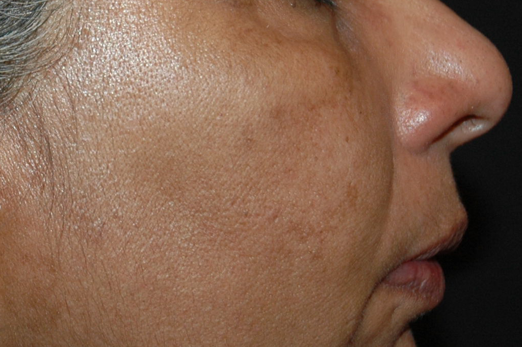 After treatment